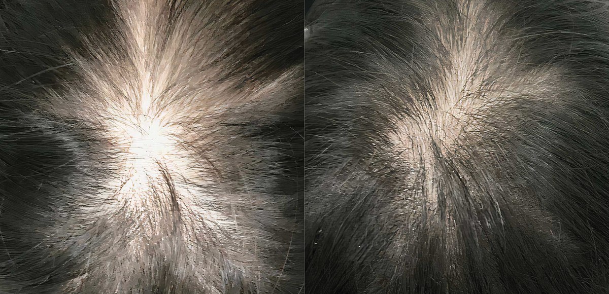 Hair loss before and after