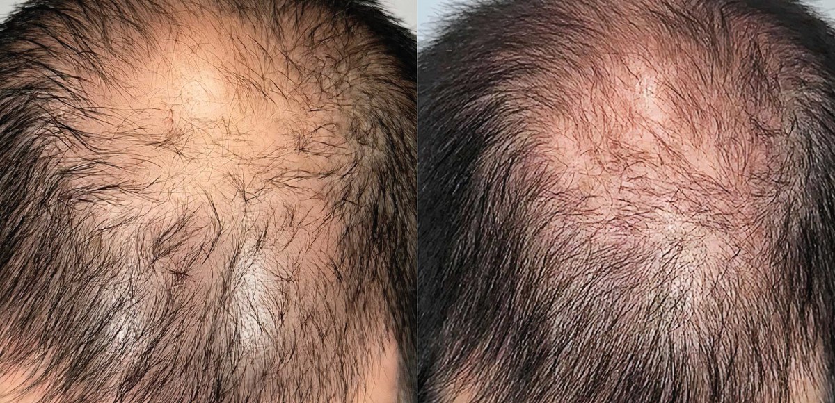 Hair loss before and after