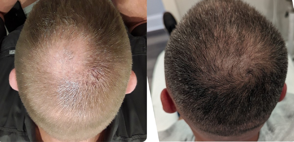 Hair loss before and after