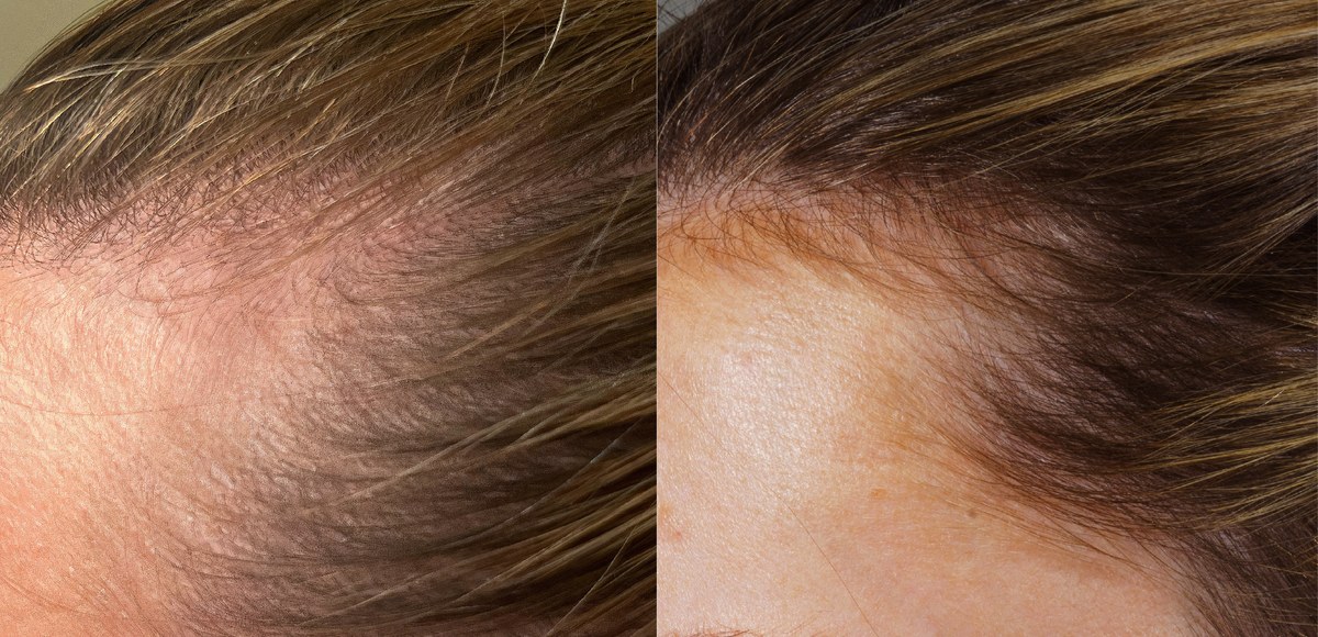 Hair loss before and after
