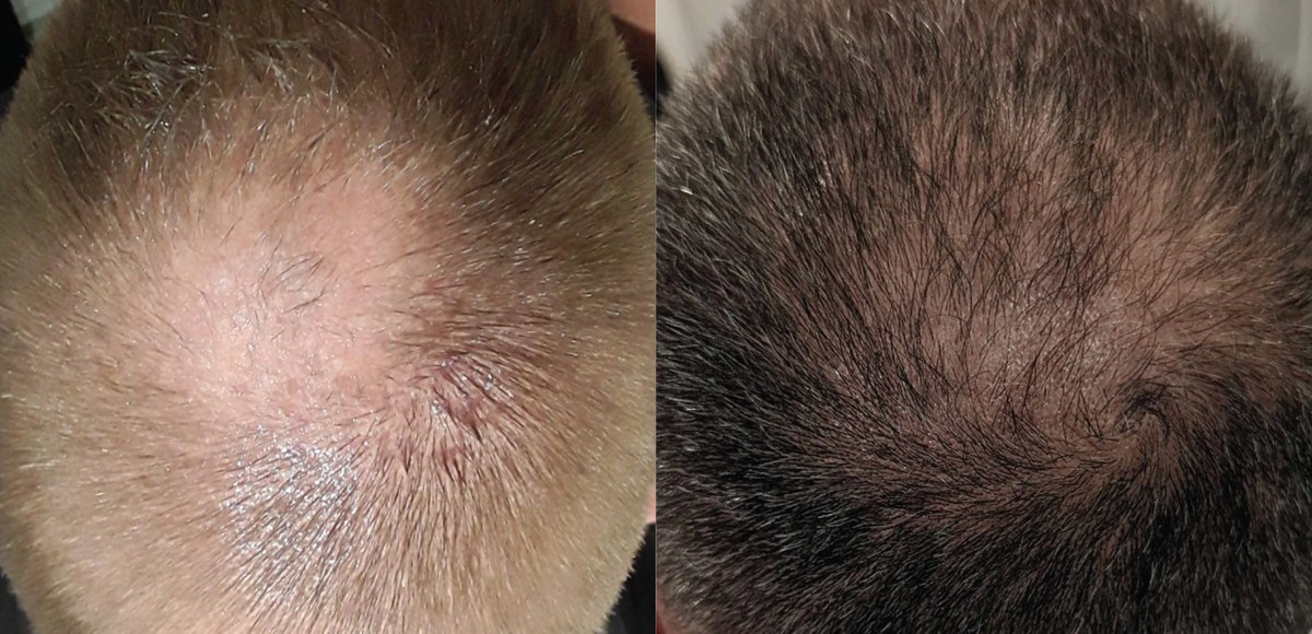 Hair loss before and after