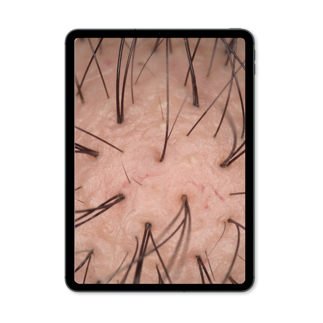 Trichoscopy view on iPad